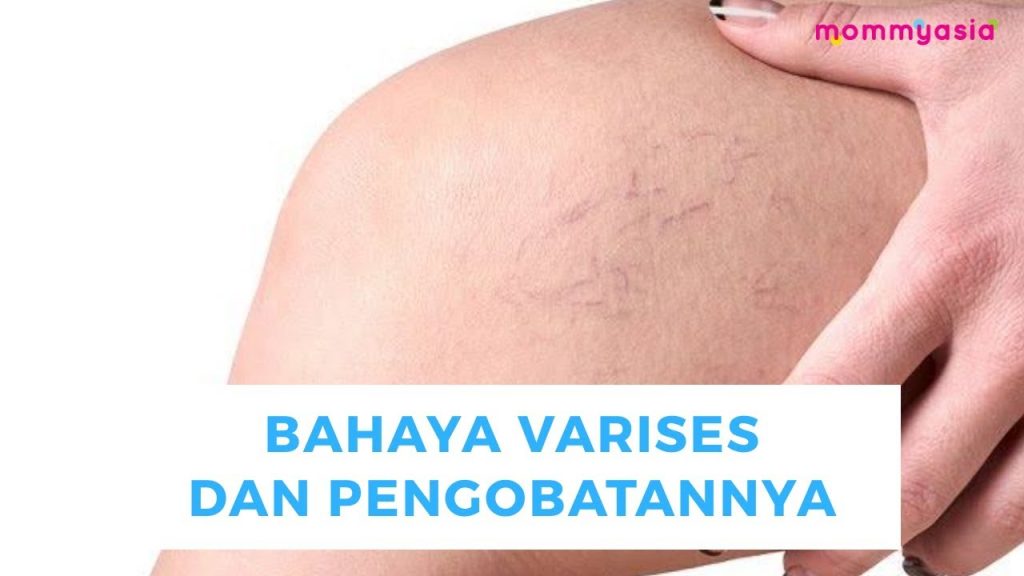 Bahaya Varises Dan Cara Mencegahnya Panduan Lengkap Untuk Kesehatan Vena Optimal