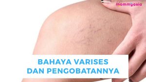 Bahaya Varises dan Cara Mencegahnya: Panduan Lengkap untuk Kesehatan Vena Optimal