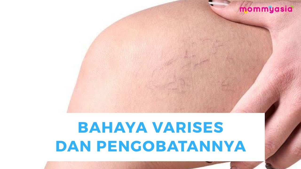 Bahaya Varises Dan Cara Mencegahnya Panduan Lengkap Untuk Kesehatan Vena Optimal